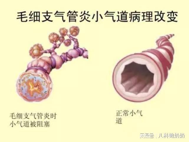 咳嗽、喘息不一定都是感冒，也有可能是这病，尤其1岁下的要警惕