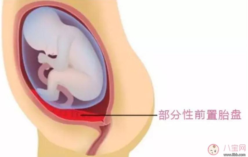 孕妇胎盘低怎么办 孕妇胎盘低是什么原因造成的(胎盘低要注意什么)